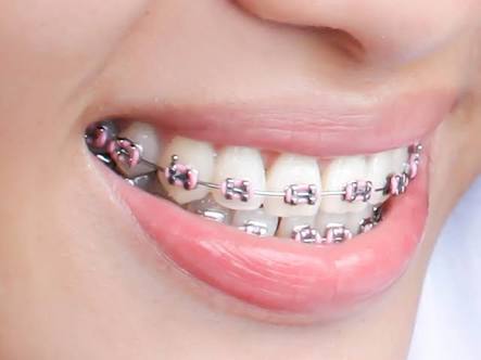Braces and orthodontic treatment in Lucknow – Saraswati Dental
