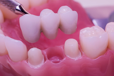Ceramic crowns and bridges in Lucknow – Saraswati Dental