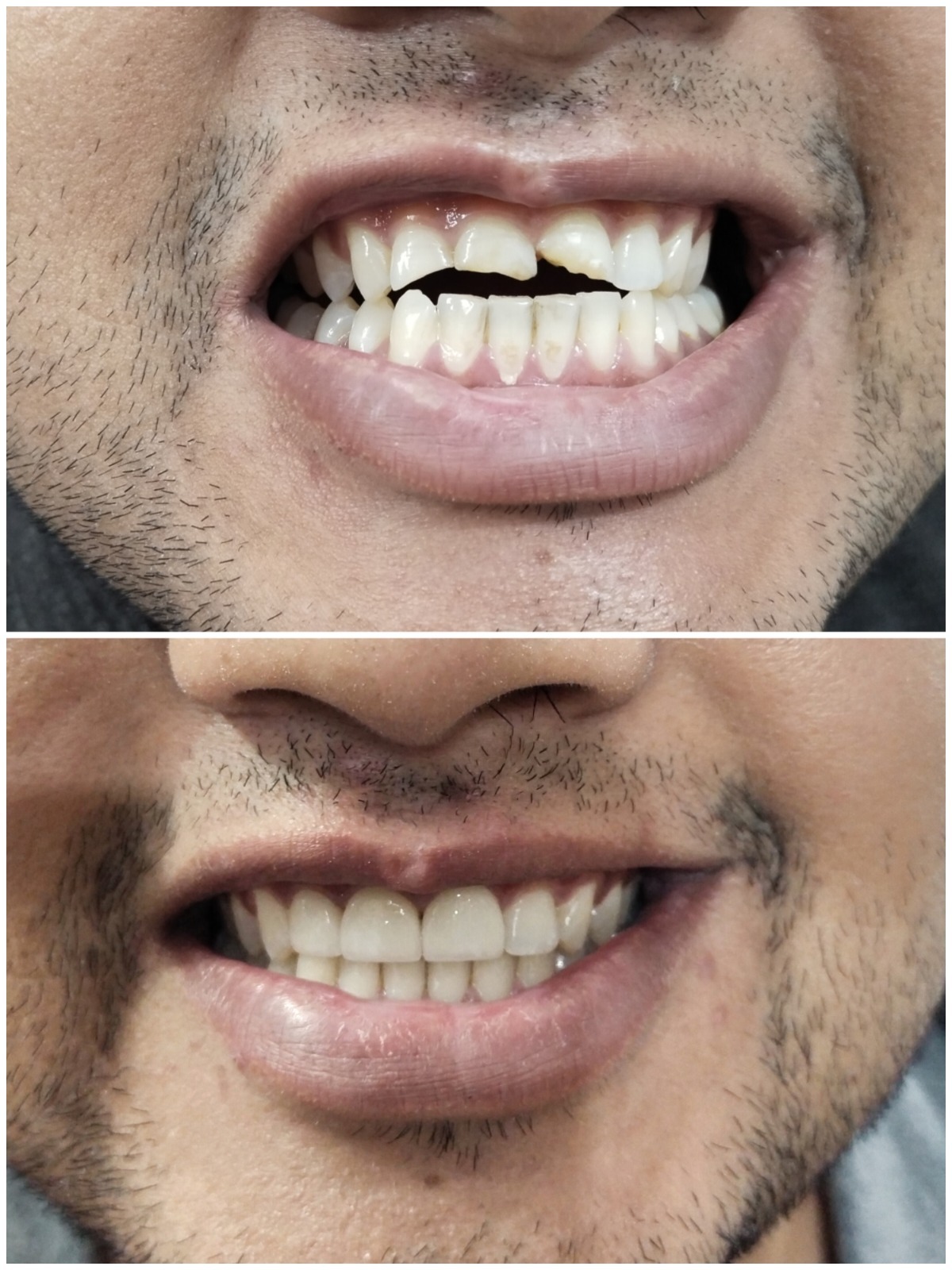Smile transformation before and after – Saraswati Dental Lucknow