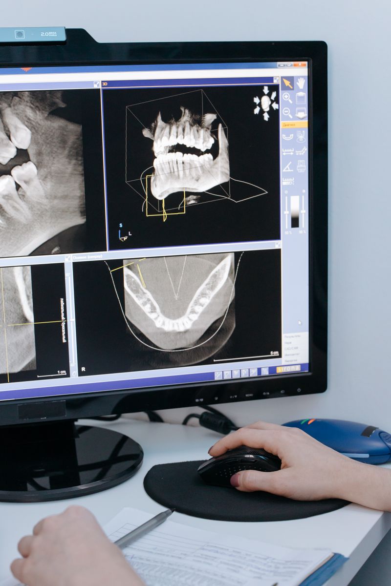 Digital RVG X-Ray – low radiation dental imaging at Saraswati Dental Lucknow
