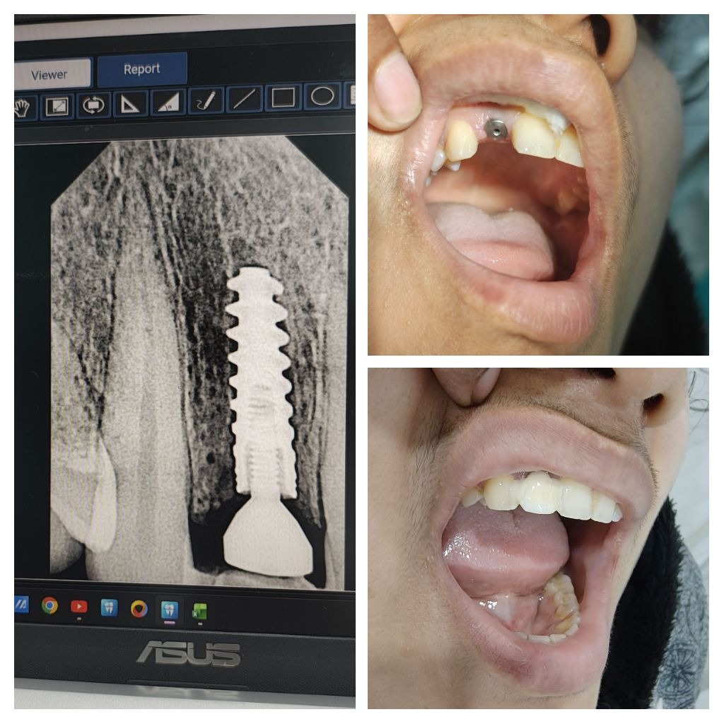 Dental implant results Lucknow – Saraswati Dental & Implant Clinic Arjunganj